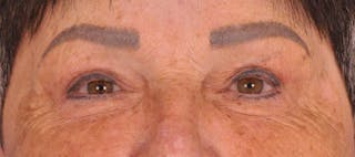 Blepharoplasty Before & After Gallery - Patient 270064 - Image 2