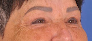 Blepharoplasty Before & After Gallery - Patient 270064 - Image 4