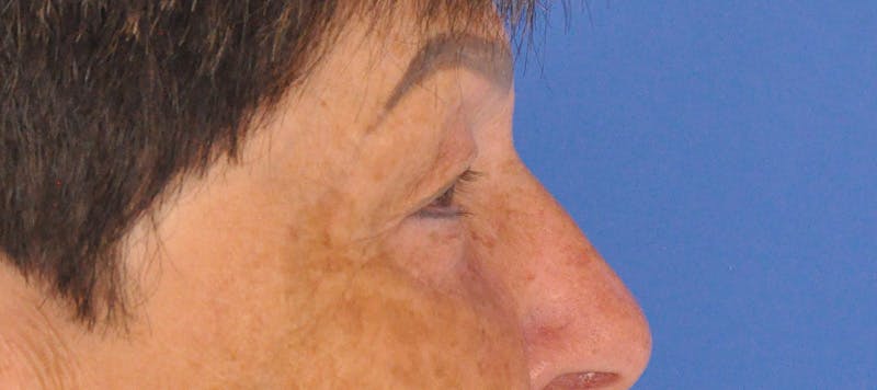 Blepharoplasty Before & After Gallery - Patient 270064 - Image 5