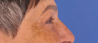 Blepharoplasty Before & After Gallery - Patient 270064 - Image 6