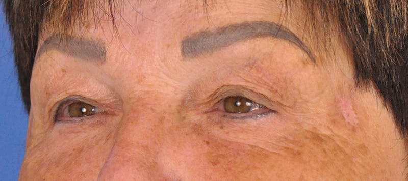 Blepharoplasty Before & After Gallery - Patient 270064 - Image 7