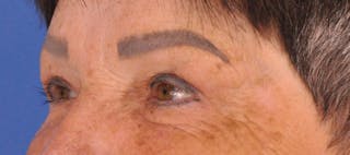 Blepharoplasty Before & After Gallery - Patient 270064 - Image 8