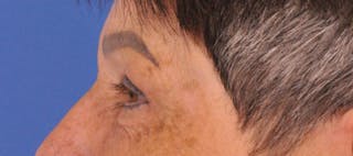 Blepharoplasty Before & After Gallery - Patient 270064 - Image 10