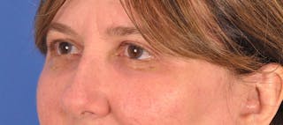 Blepharoplasty Before & After Gallery - Patient 207027 - Image 6