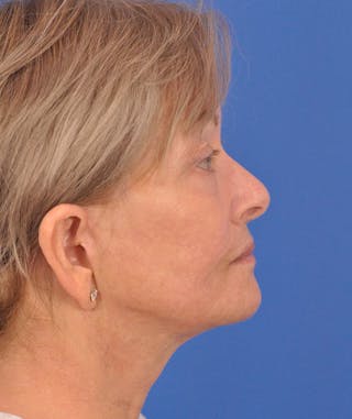 Facelift Before & After Gallery - Patient 114539 - Image 6