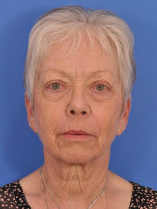 CO2RE Laser Before & After Gallery - Patient 580844 - Image 2