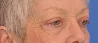 Blepharoplasty Before & After Gallery - Patient 254454 - Image 4
