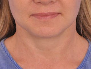 Neck Lift Before & After Gallery - Patient 122286 - Image 6