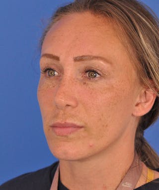 Rhinoplasty Before & After Gallery - Patient 323292 - Image 8