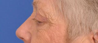 Blepharoplasty Before & After Gallery - Patient 254454 - Image 10