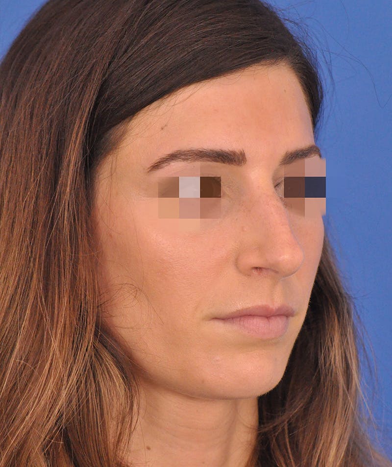 Rhinoplasty Before & After Gallery - Patient 398005 - Image 3