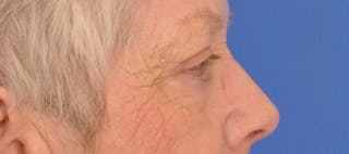 Blepharoplasty Before & After Gallery - Patient 254454 - Image 6