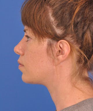 Facelift Before & After Gallery - Patient 882582 - Image 8