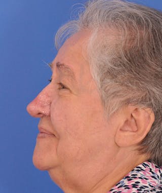 CO2RE Laser Before & After Gallery - Patient 305140 - Image 10