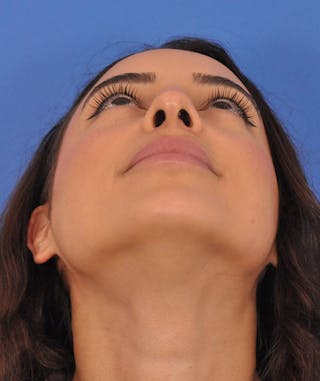Rhinoplasty Before & After Gallery - Patient 788052 - Image 4