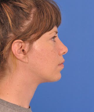 Facelift Before & After Gallery - Patient 882582 - Image 6