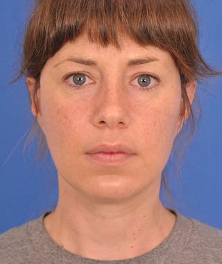 Facelift Before & After Gallery - Patient 882582 - Image 2