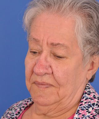 CO2RE Laser Before & After Gallery - Patient 305140 - Image 8