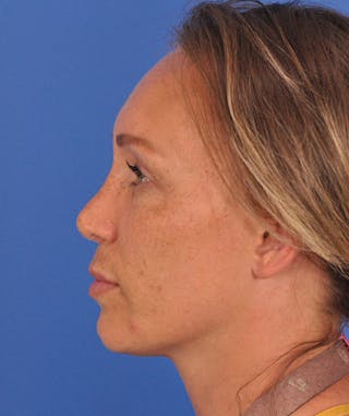 Rhinoplasty Before & After Gallery - Patient 323292 - Image 10