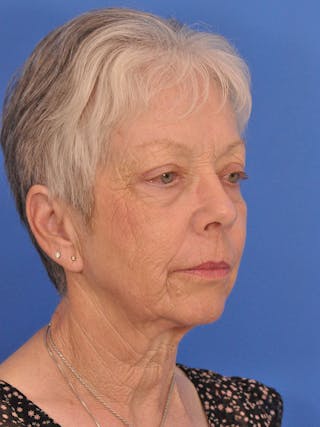 CO2RE Laser Before & After Gallery - Patient 580844 - Image 4