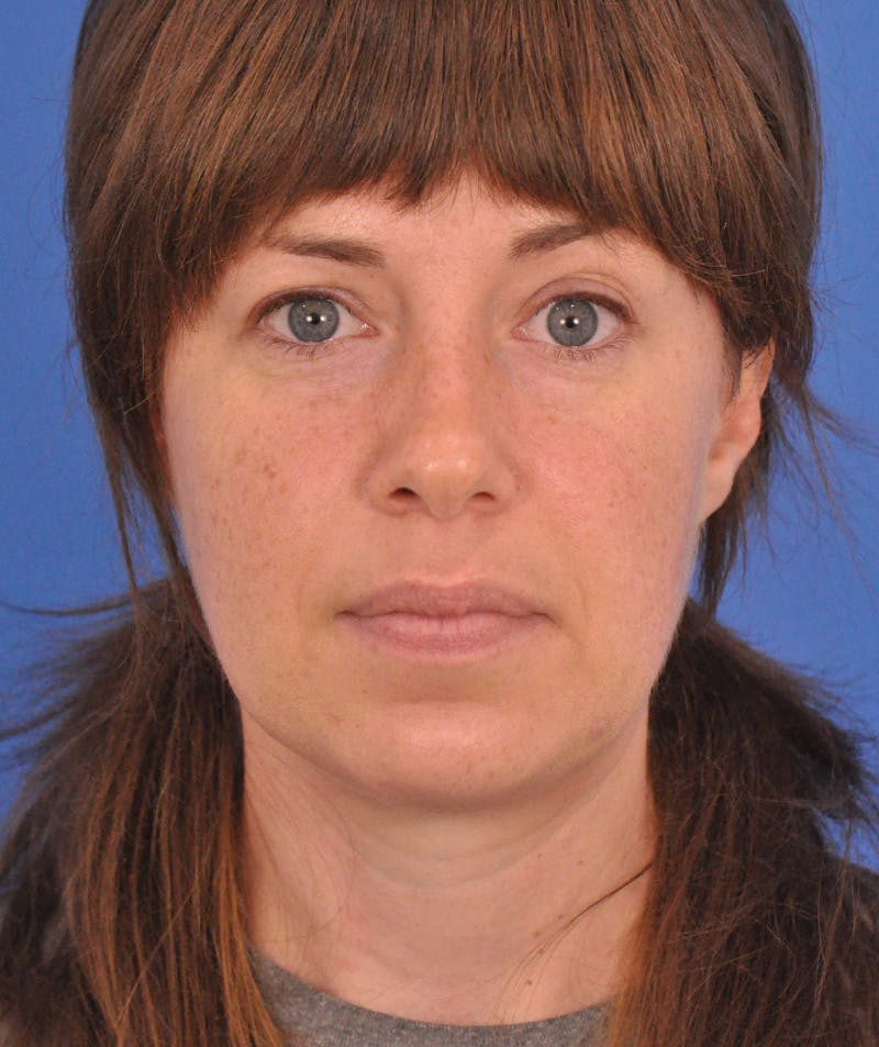 procedure5