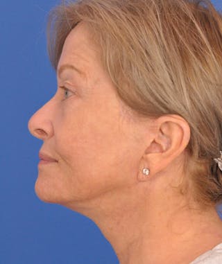 Facelift Before & After Gallery - Patient 114539 - Image 10