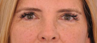 Blepharoplasty Before & After Gallery - Patient 152543 - Image 4