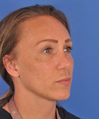 Rhinoplasty Before & After Gallery - Patient 323292 - Image 4