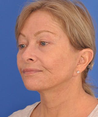 Facelift Before & After Gallery - Patient 114539 - Image 8