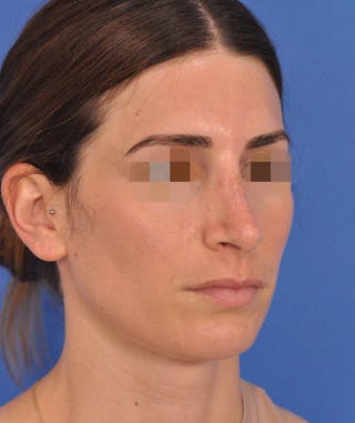 Rhinoplasty Before & After Gallery - Patient 398005 - Image 4