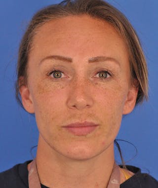 Rhinoplasty Before & After Gallery - Patient 323292 - Image 6