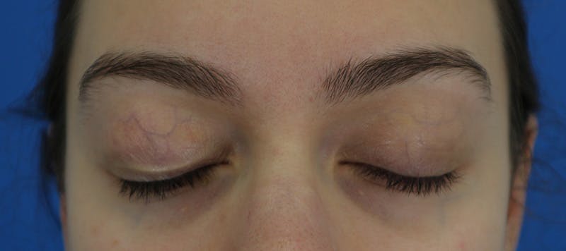 Blepharoplasty Before & After Gallery - Patient 280564 - Image 3