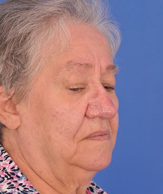 CO2RE Laser Before & After Gallery - Patient 305140 - Image 4