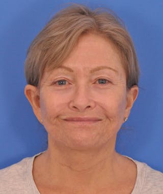 Facelift Before & After Gallery - Patient 114539 - Image 2