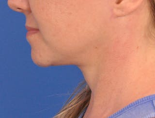 Neck Lift Before & After Gallery - Patient 122286 - Image 10