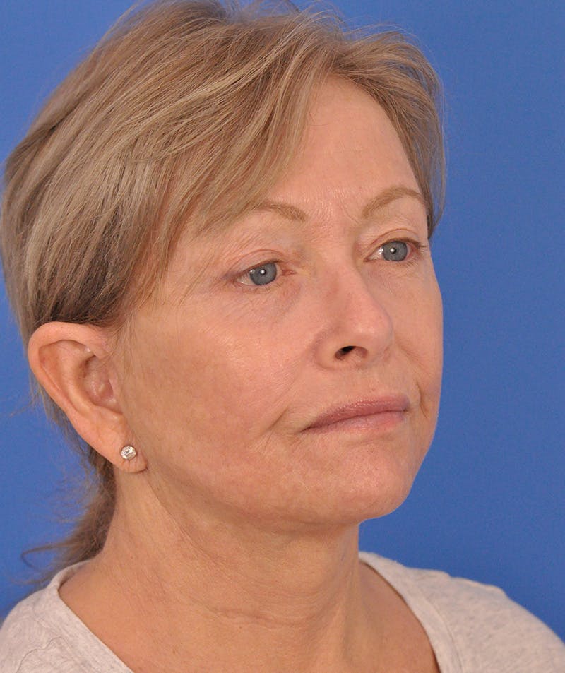 Facelift Before & After Gallery - Patient 114539 - Image 4
