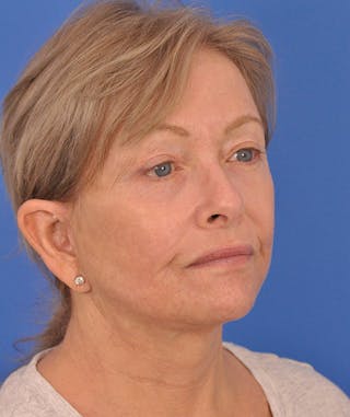 Facelift Before & After Gallery - Patient 114539 - Image 4