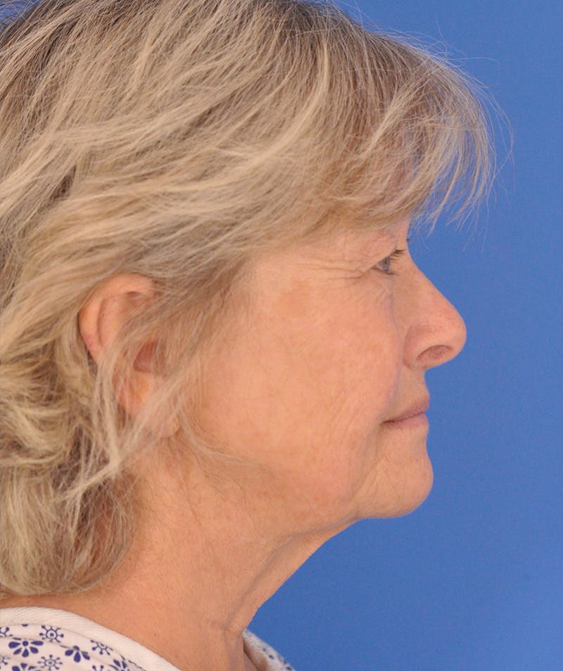Facelift Before & After Gallery - Patient 114539 - Image 5