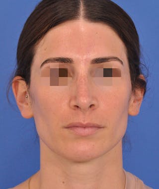 Rhinoplasty Before & After Gallery - Patient 398005 - Image 6