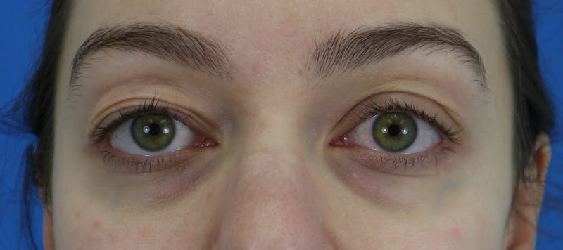 Blepharoplasty Before & After Gallery - Patient 280564 - Image 1