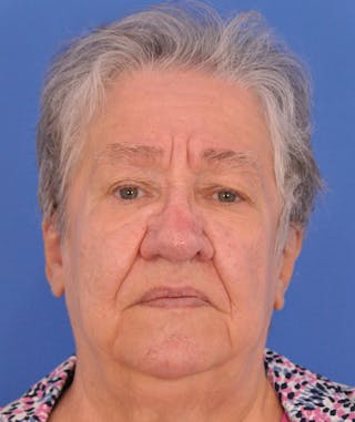 CO2RE Laser Before & After Gallery - Patient 305140 - Image 2