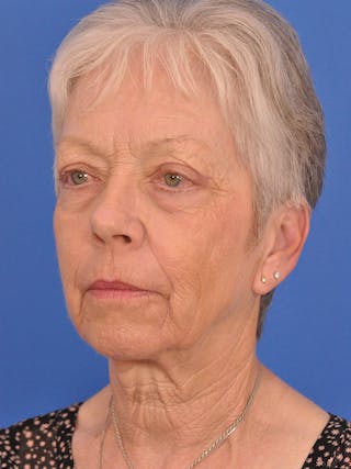 CO2RE Laser Before & After Gallery - Patient 580844 - Image 8