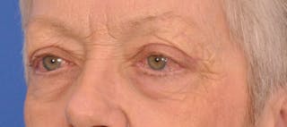 Blepharoplasty Before & After Gallery - Patient 254454 - Image 8