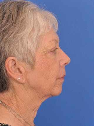 CO2RE Laser Before & After Gallery - Patient 580844 - Image 6