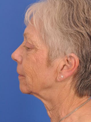 CO2RE Laser Before & After Gallery - Patient 580844 - Image 10