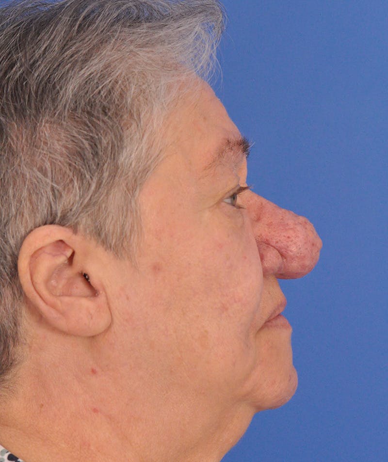 CO2RE Laser Before & After Gallery - Patient 305140 - Image 5