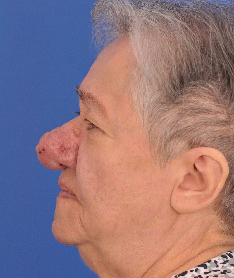 CO2RE Laser Before & After Gallery - Patient 305140 - Image 9