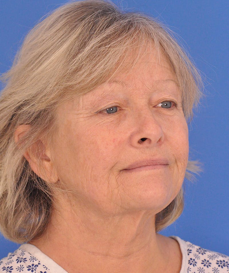 Facelift Before & After Gallery - Patient 114539 - Image 3
