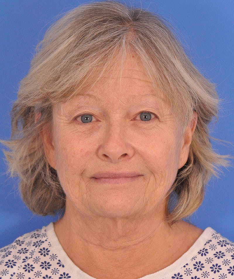 Facelift Before & After Gallery - Patient 114539 - Image 1