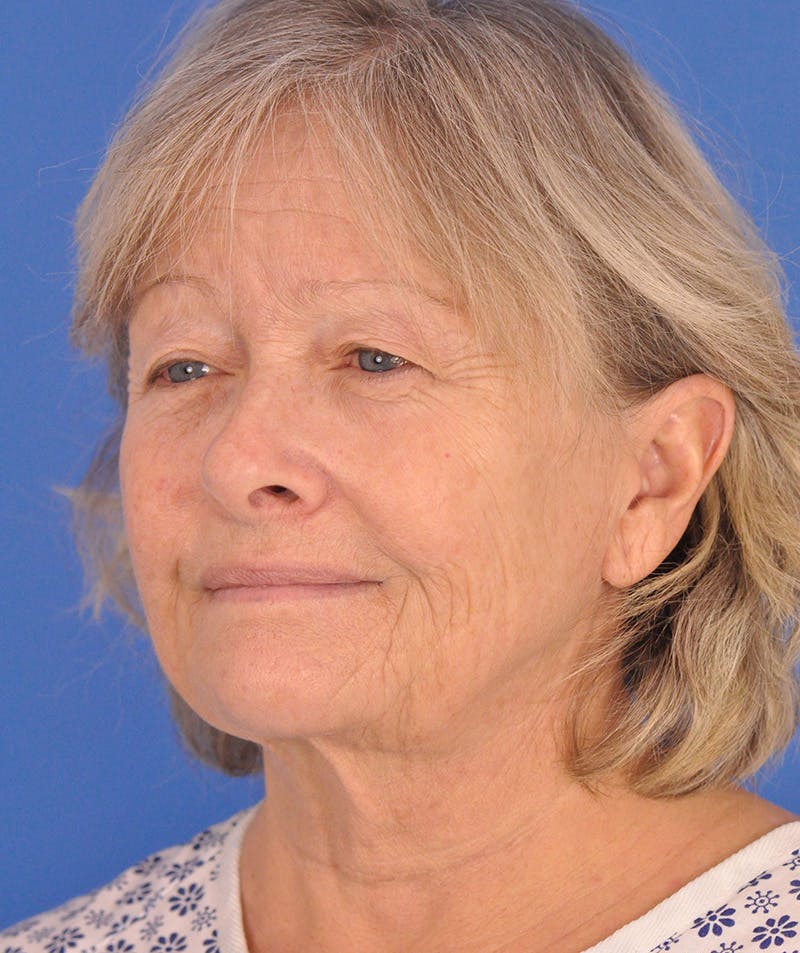 Facelift Before & After Gallery - Patient 114539 - Image 7